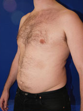 Male Liposuction