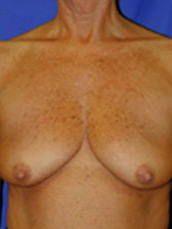 Breast Augmentation & Lift