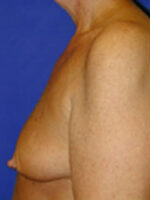 Breast Augmentation & Lift