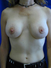 Breast Augmentation & Lift
