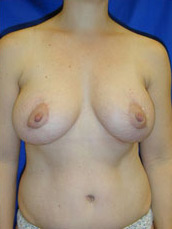 Breast Augmentation & Lift