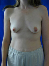 Breast Augmentation & Lift