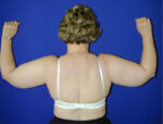 Liposuction