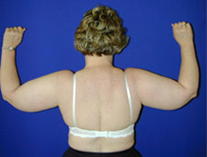 Liposuction