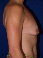 Breast Augmentation & Lift