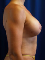 Breast Augmentation & Lift