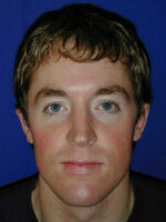 Otoplasty
