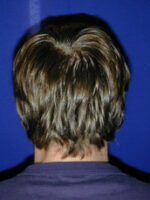 Otoplasty