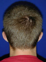 Otoplasty