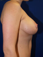 Breast Augmentation & Lift