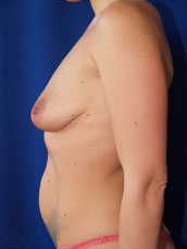 Breast Augmentation & Lift