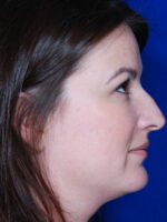 Rhinoplasty