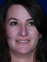 Rhinoplasty
