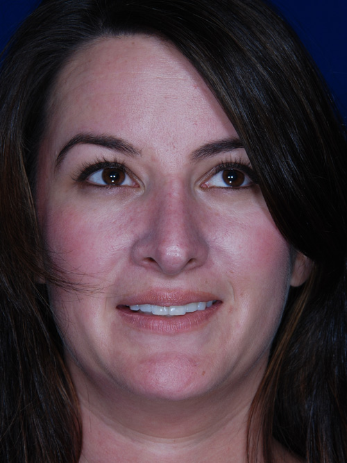 Rhinoplasty
