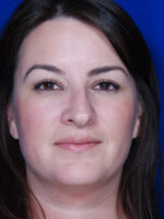 Rhinoplasty