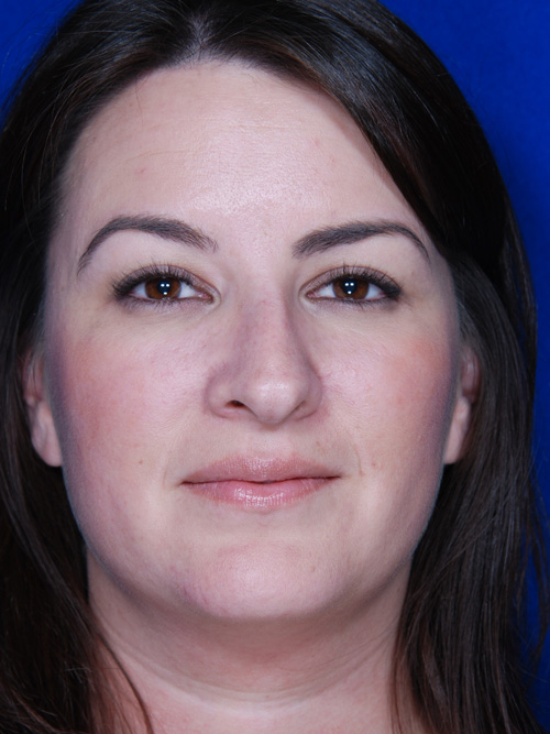 Rhinoplasty