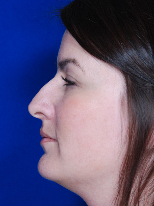Rhinoplasty