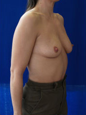 Breast Augmentation & Lift