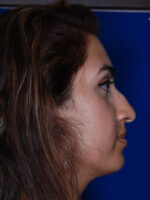 Rhinoplasty
