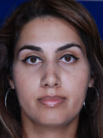 Rhinoplasty