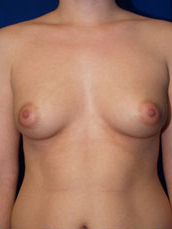 Breast Augmentation