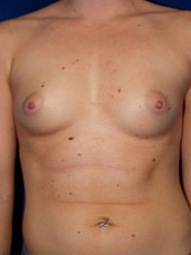 Breast Augmentation