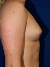 Breast Augmentation