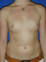 Breast Augmentation