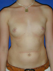 Breast Augmentation