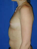 Breast Augmentation