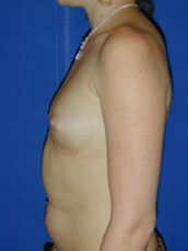 Breast Augmentation