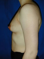Breast Augmentation