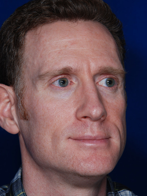 Rhinoplasty