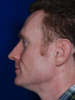 Rhinoplasty
