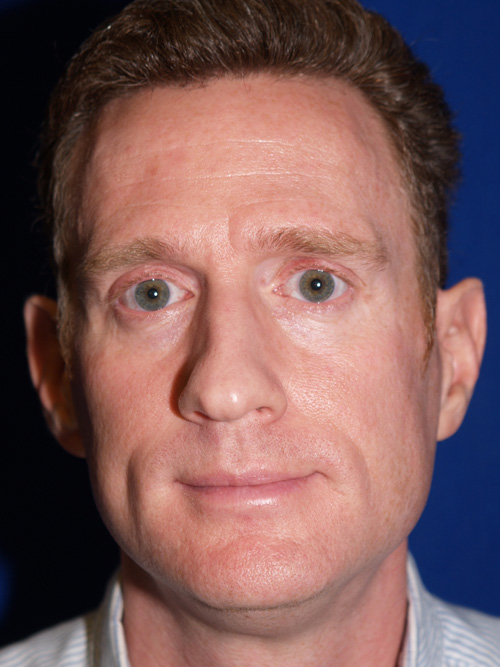 Rhinoplasty