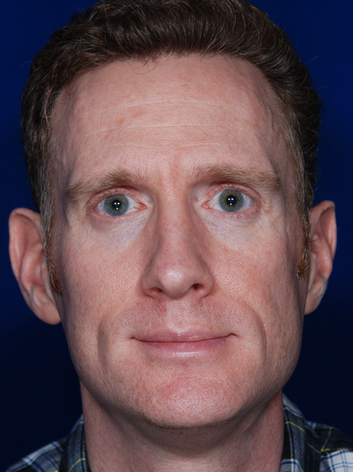 Rhinoplasty