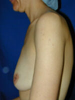Breast Augmentation