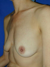 Breast Augmentation