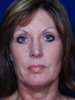 Rhinoplasty