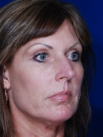 Rhinoplasty