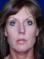 Rhinoplasty