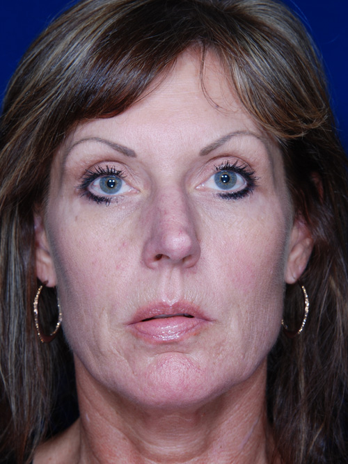 Rhinoplasty