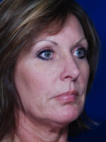 Rhinoplasty