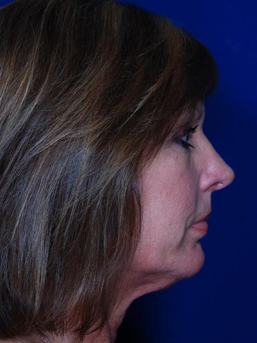 Rhinoplasty