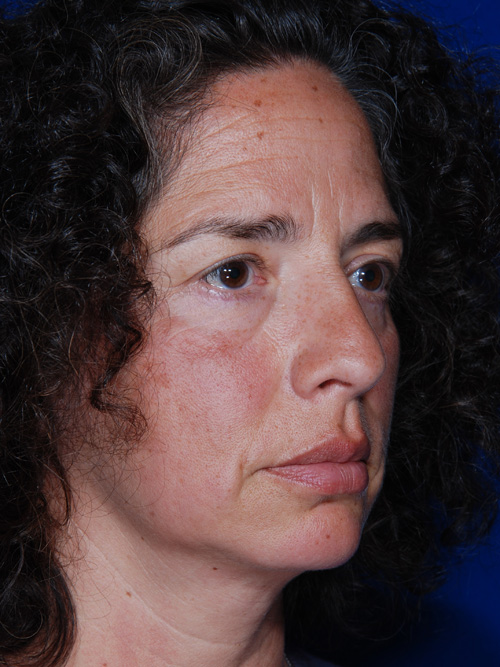 Eyelid Lift