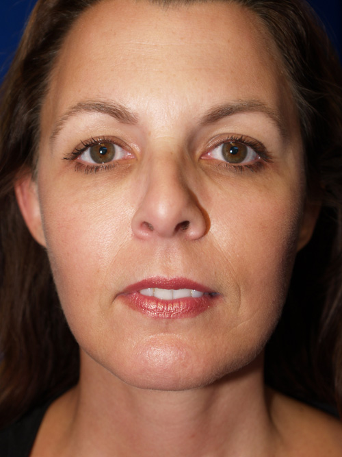 Facelift