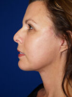 Facelift