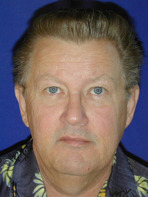 Male Blepharoplasty