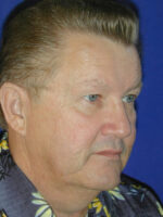 Male Blepharoplasty