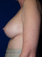 Breast Augmentation